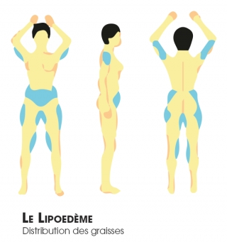 Le lipoedème